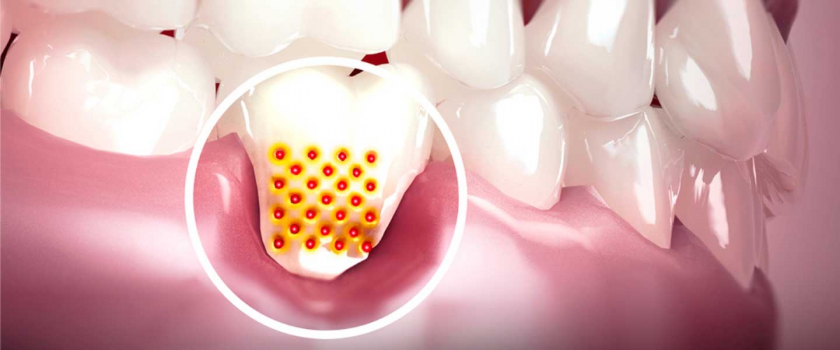 Diş eti hastalıkları (periodontoloji) 
